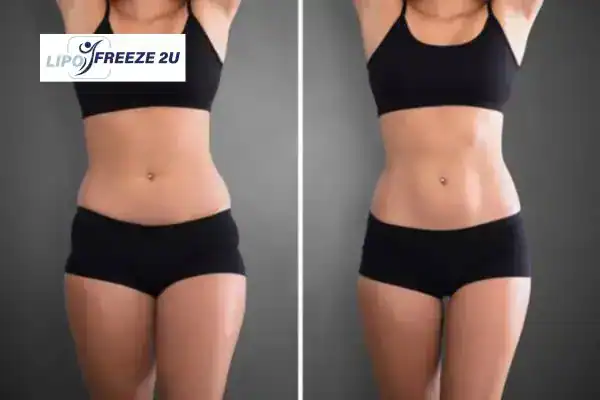 How Can LIPO FREEZE 2U Support Your Post-Pregnancy Body Recovery Leeds?