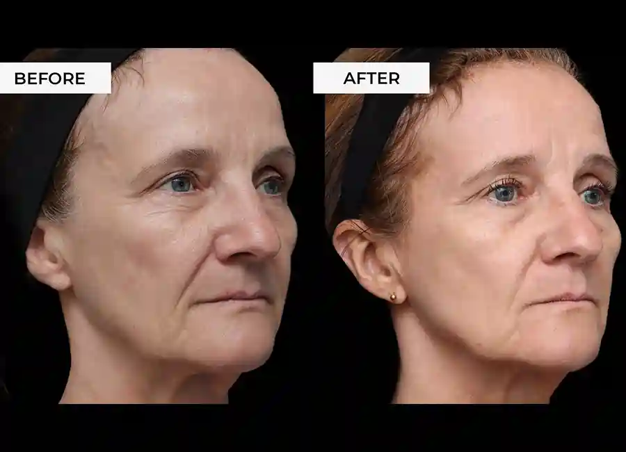 How Many RF Microneedling Sessions Will You Need to See a Difference Leeds?