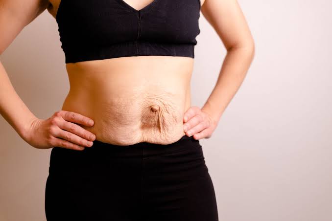 Is Surgery Really the Only Way to Repair Diastasis Recti Leeds?