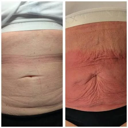 How Does RF Microneedling Improve Crepey, Thin and Uneven Skin Texture Leeds?