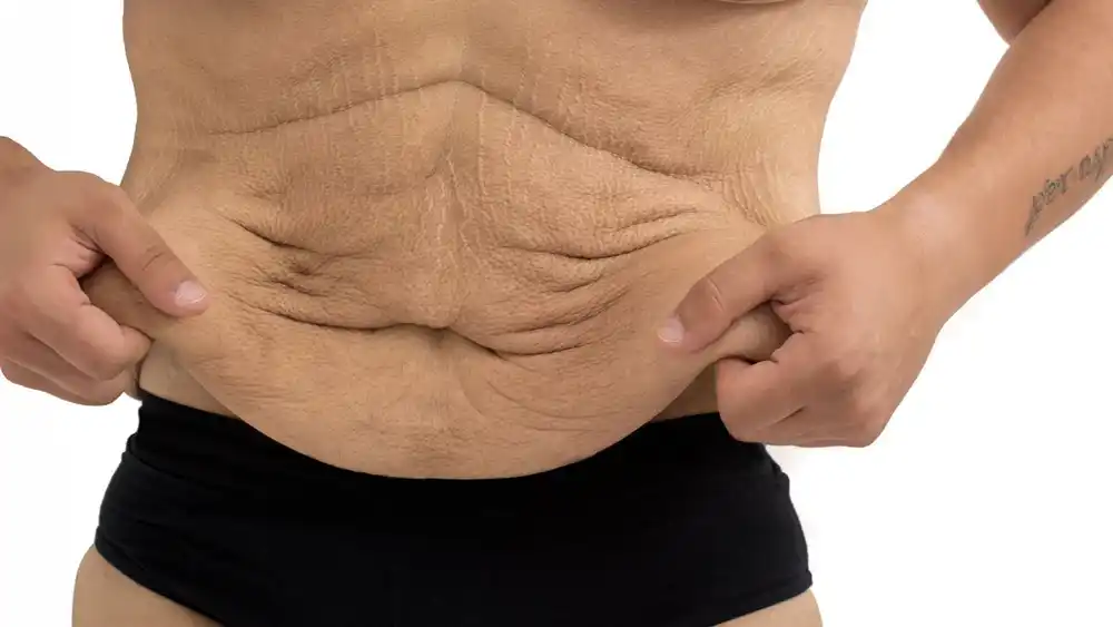 Why Does Weight Loss Medication Leave Some People With Loose or Sagging Skin Leeds?